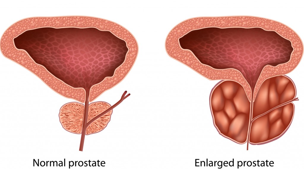 Benign prostatic hyperplasia (prostatic hypertrophy)