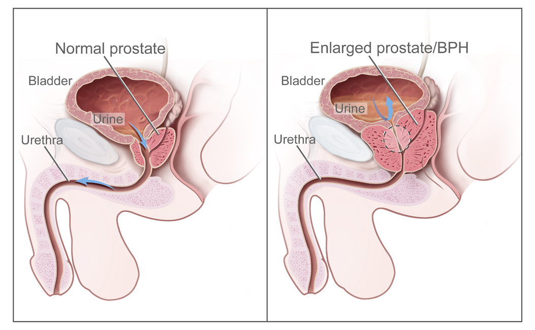 ENLARGED PROSTATE GLAND