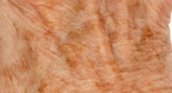 BYE-BYE DARK SPOTS!