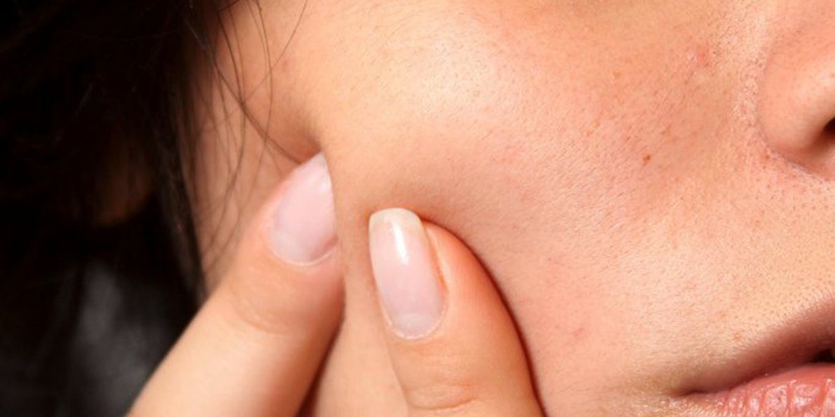BLACKHEAD REMOVAL—WITHOUT THE HASSLES