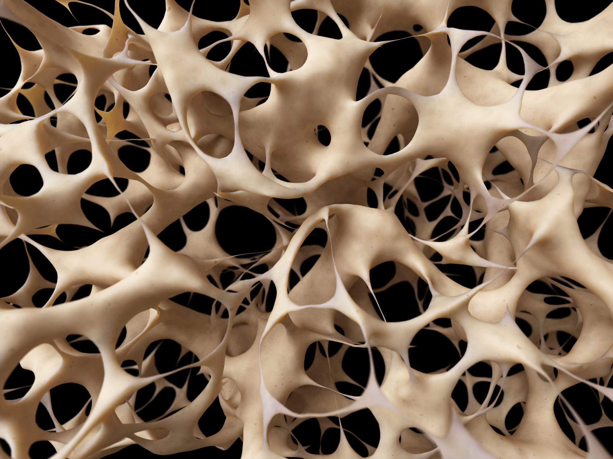 LOW BONE DENSITY
