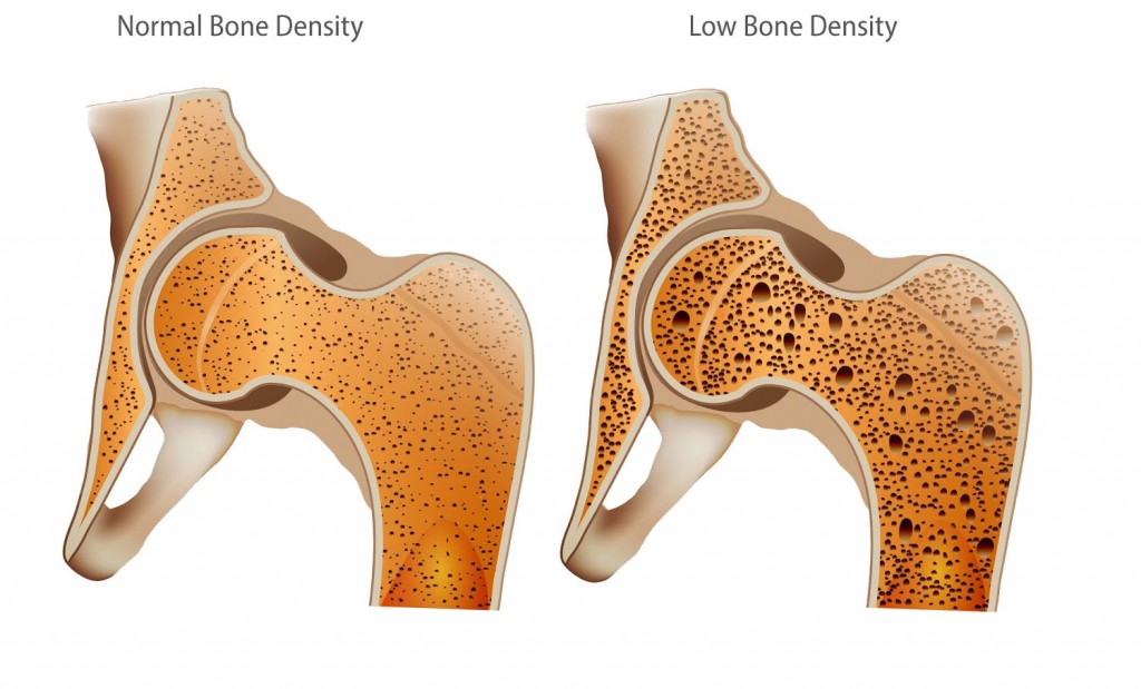 low bone density 2-middle of the article