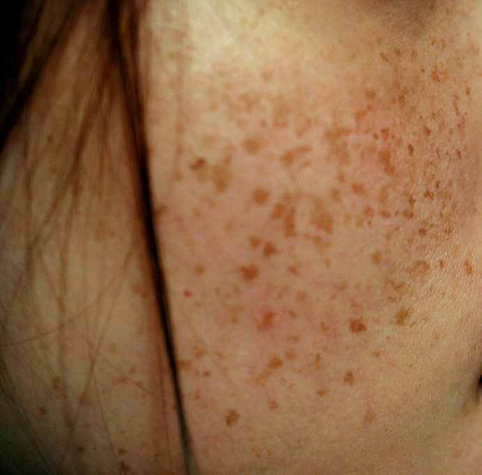 EXPERIENCING SKIN DISCOLORATION DURING PREGNANCY?