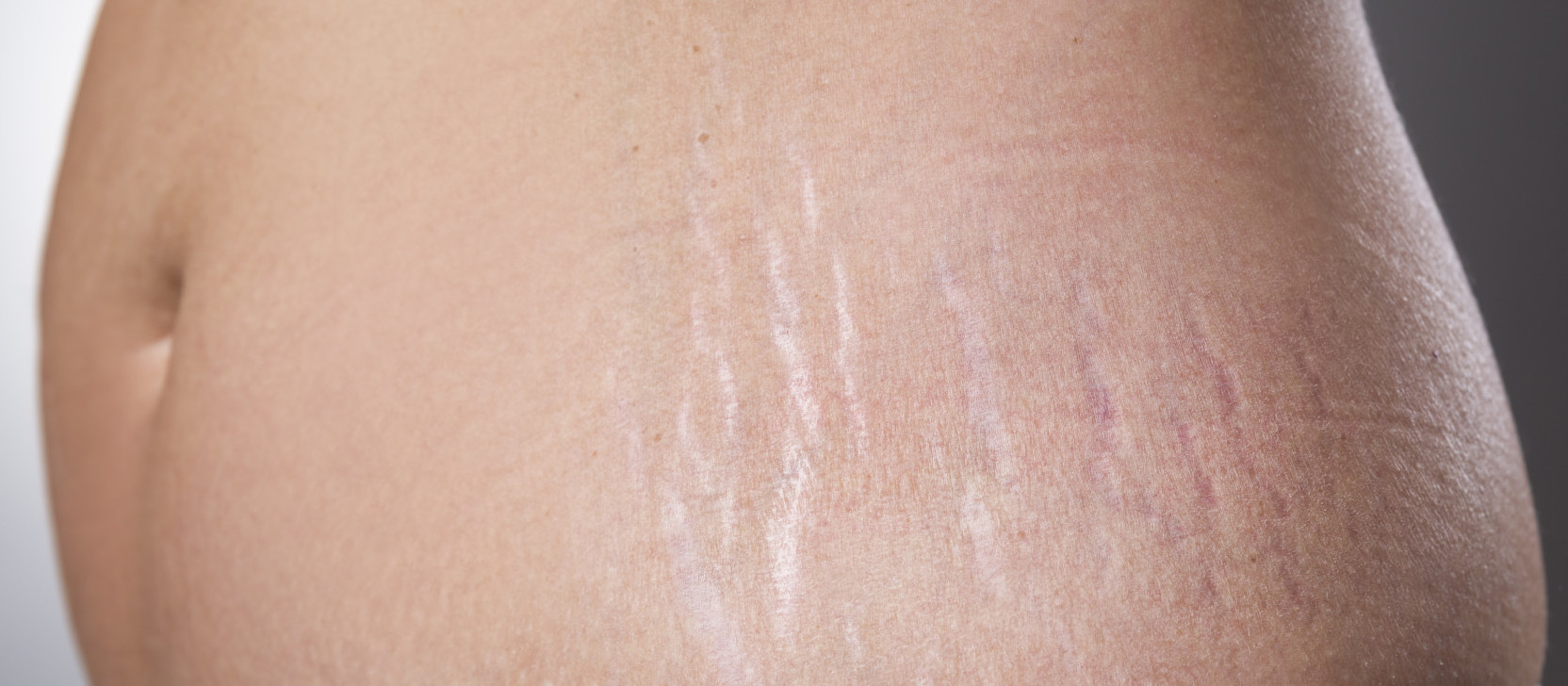Female belly with pregnancy stretch marks closeup on a gray background