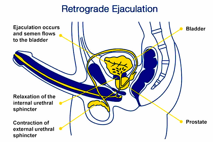 RETROGRADE EJACULATION