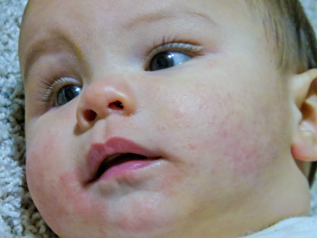 BABY ECZEMA