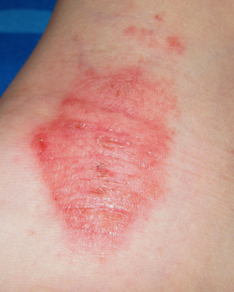 BABY ECZEMA