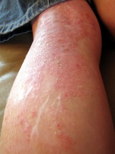 SUFFERING FROM ECZEMA 2