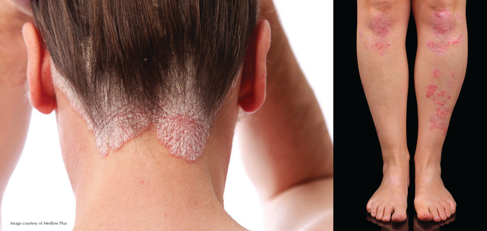 PSORIASIS
