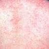 Measles cover