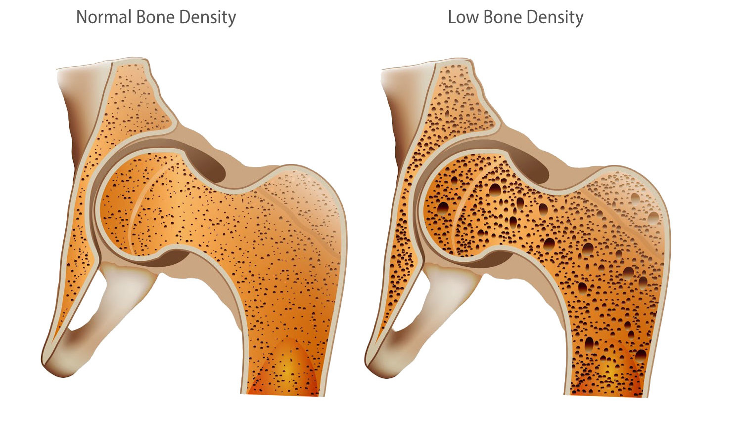 Bone mineral. Остеопороз кости. Норма и остеопороз. Люди с остеопорозом. Остеопороз фото.